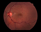 Central Retinal Vein Occlusion