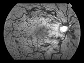 Central Retinal Vein Occlusion