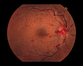 Central Retinal Vein Occlusion