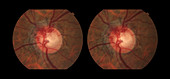 Collateral Vessels in Glaucoma Patient