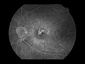 Dry Age-Related Macular Degeneration