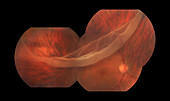 Retinal Tear