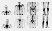 Bone scan showing multiple metastases