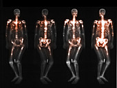 Bone scan showing multiple metastases