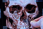 CT Scan of Skull