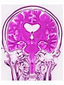 Brain MRI,White Matter Hyperintensities