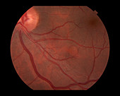 Retinal Cyst