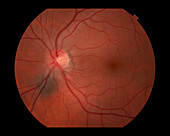 Choroidal Nevus