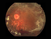 Proliferative Diabetic Retinopathy