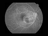 Subretinal Cyst