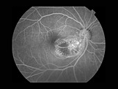 Subretinal Cyst