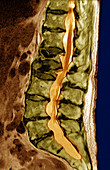 Lumbar Compression Fracture,MRI
