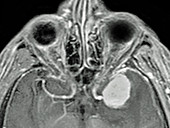 Neuroma,MRI