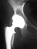 Hip Replacement,X-ray