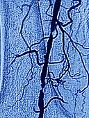 Stenosis on Femoral Artery
