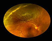 Retinal Detachment