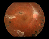 Proliferative Diabetic Retinopathy