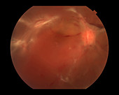 Proliferative Diabetic Retinopathy