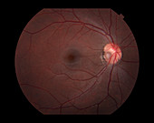 Congenital Optic Nerve Pit