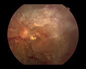 Proliferative Diabetic Retinopathy