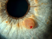 Iris Cyst