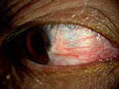 Pterygium