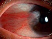 Pterygium