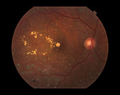 Proliferative Diabetic Retinopathy