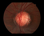 Glaucoma