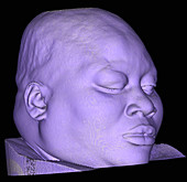 Enhanced 3DCT Image of Facial Trauma