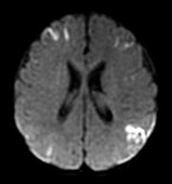 MRI Meningitis In Newborn