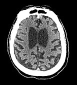 CT of Alzheimer Disease