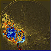 Enhanced Temporal Lobe AVM on Angiography