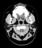 Benign Masseteric Hypertrophy on CT