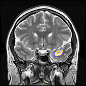 Enhanced Cerebral Cavernous Malformation