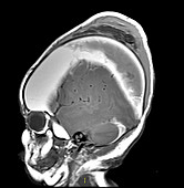 Extensive Birth Injury MRI
