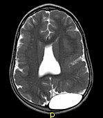 Congenital Brain Malformations on MRI