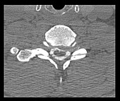 Cervical Myelogram CT