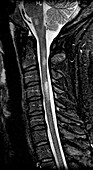 Sclerosis of Cervical Spinal Cord