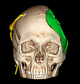 Enhanced 3D CT of Craniotomy