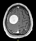 Large Meningioma on MRI