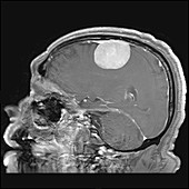 Large Meningioma on MRI