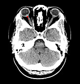 Elevated Optic Discs in Pseudotumour