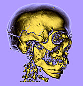 Enhanced 3D CT of Skull Fracture