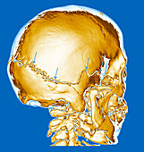 Enhanced 3D CT of Skull Fracture