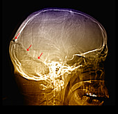 Enhanced Skull Fracture on X-Ray