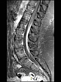 Guillain-Barre on MRI