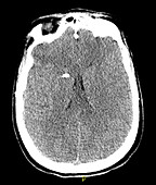 Severe Traumatic Brain Injury,CT Scan