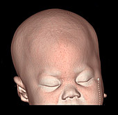 Trigononcephaly,3D CT Scan