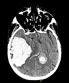 Massive Intracranial Hemorrhage,CT Scan